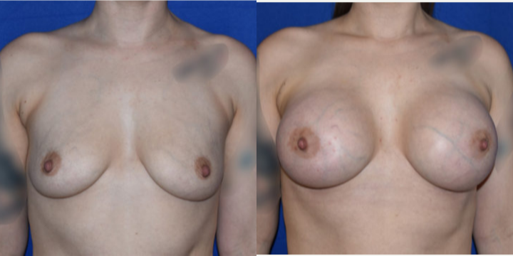 Breast Lift (Mastopexy) procedure image
