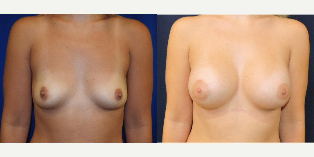 Breast Augmentation procedure image