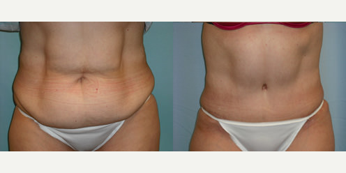 Mommy Makeover procedure image