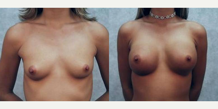 Mommy Makeover procedure image