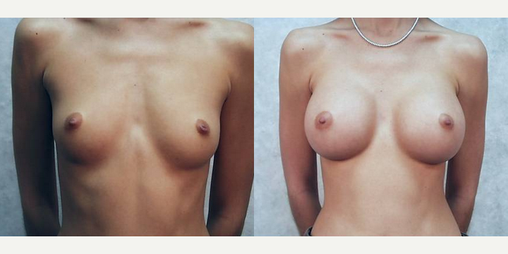 Breast Augmentation procedure image