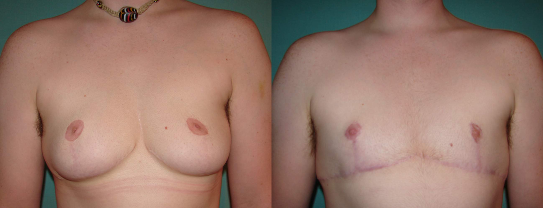 Mommy Makeover procedure image