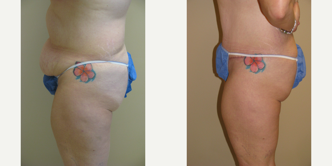 Skin Tightening procedure image