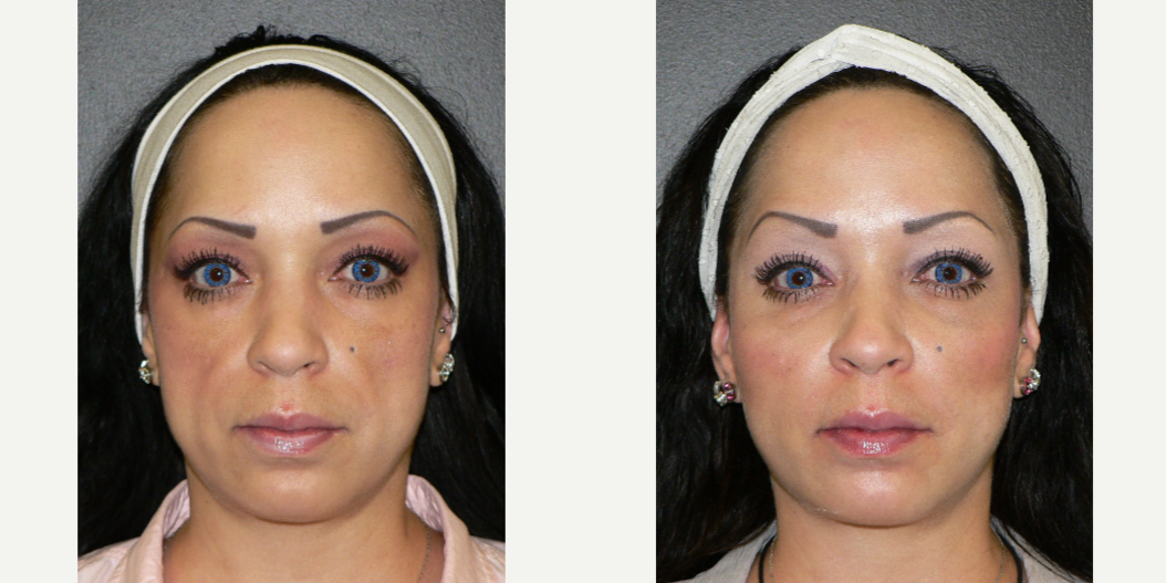 Rhinoplasty (Nose Job) procedure image