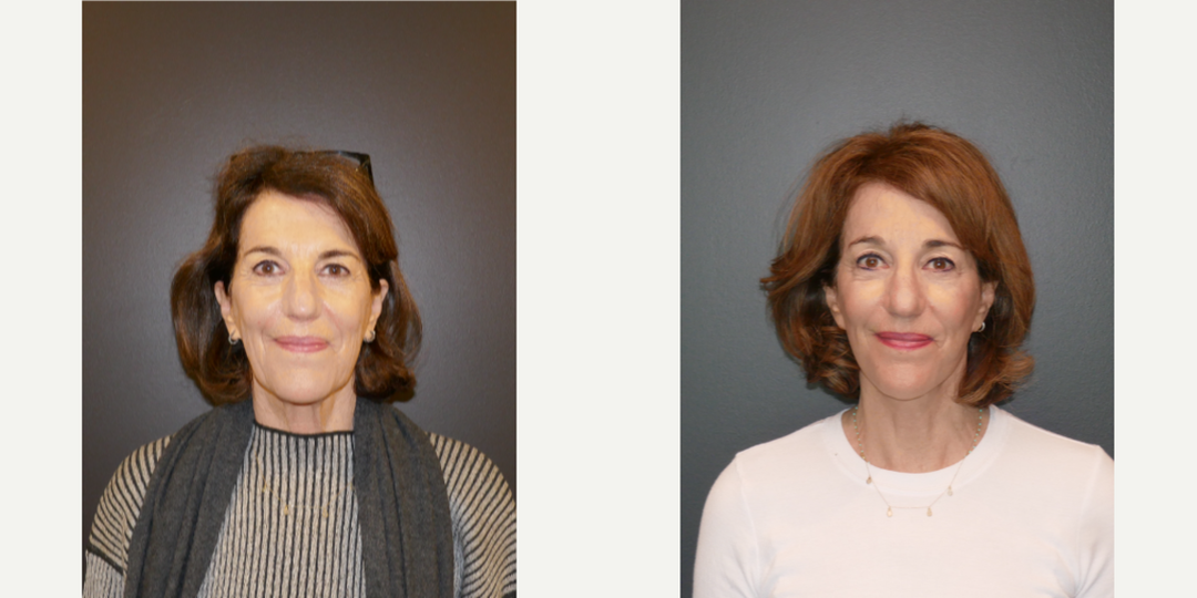 Facelift procedure image