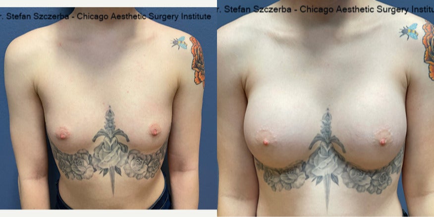 Breast Augmentation procedure image