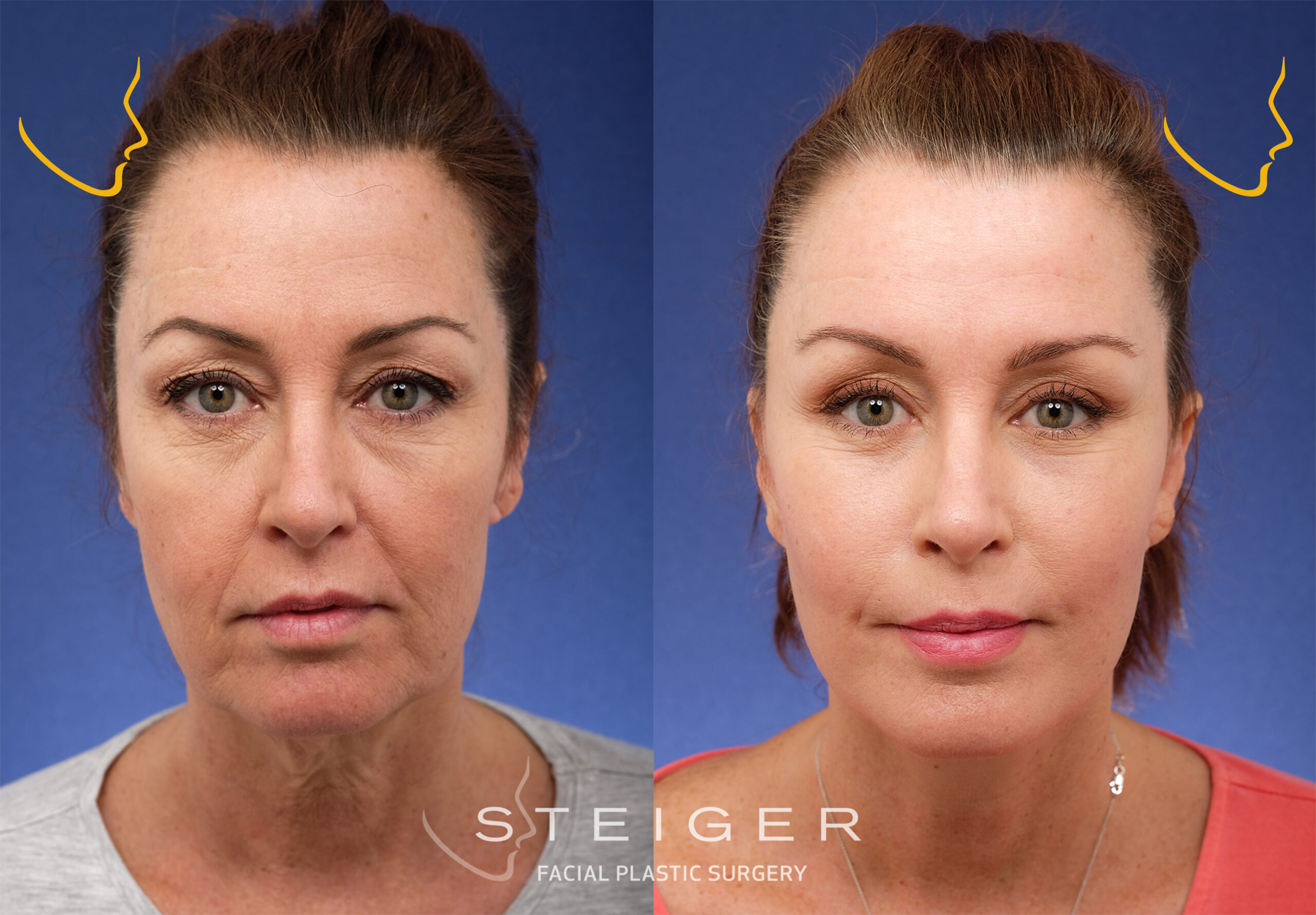 Facelift procedure image