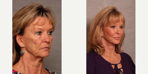 Facelift procedure image