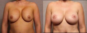 Breast Augmentation procedure image