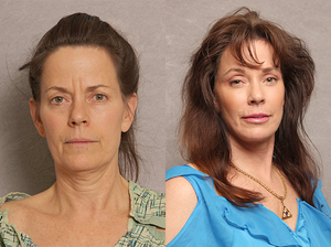 Chin Implant procedure image