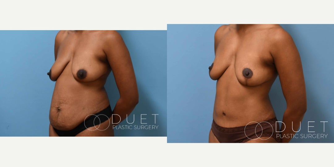 Mommy Makeover procedure image