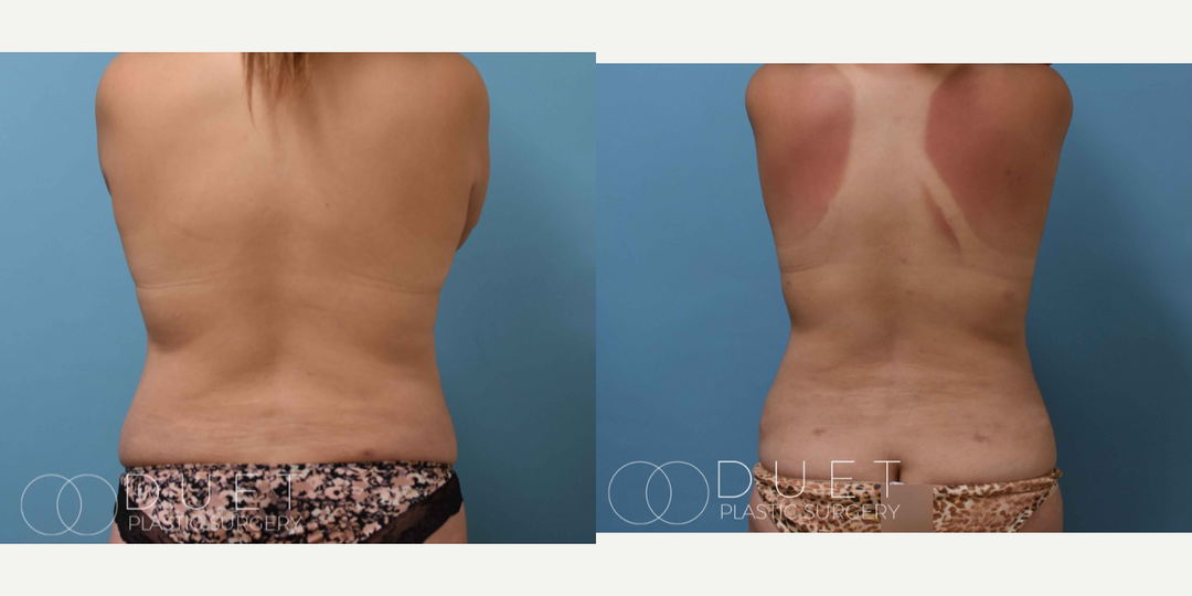 Skin Tightening procedure image