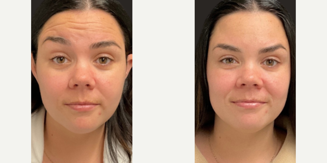 Fillers & Injectables (e.g. Botox, Juvederm) procedure image