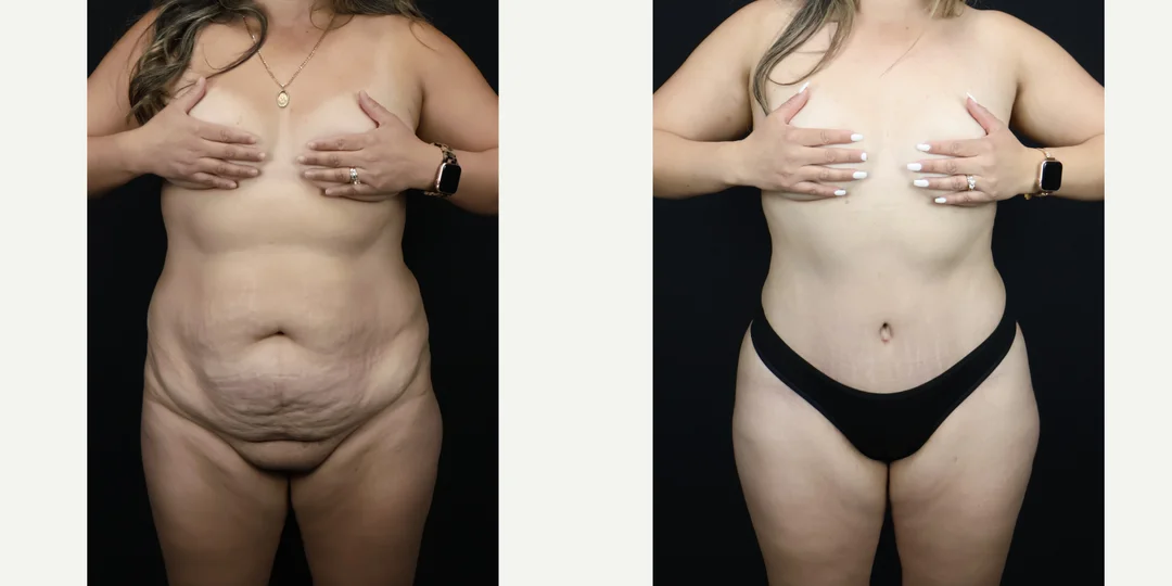 Skin Tightening procedure image