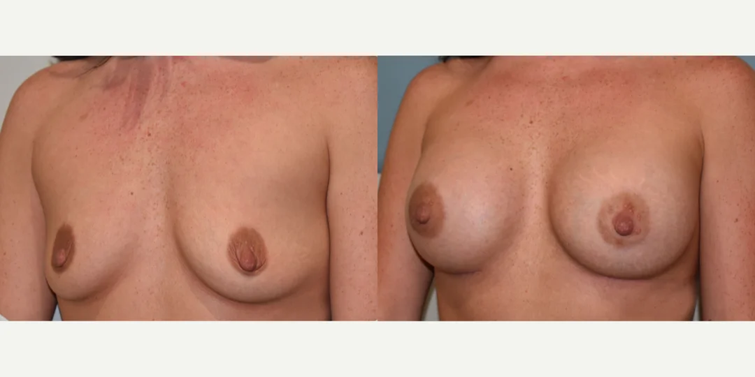 Breast Augmentation procedure image