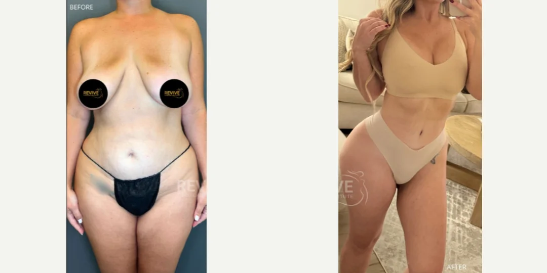 Skin Tightening procedure image