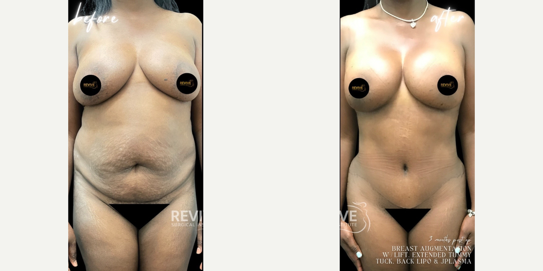 Mommy Makeover procedure image