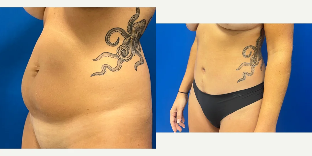 Tummy Tuck (Abdominoplasty) procedure image