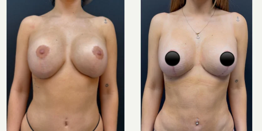 Mommy Makeover procedure image