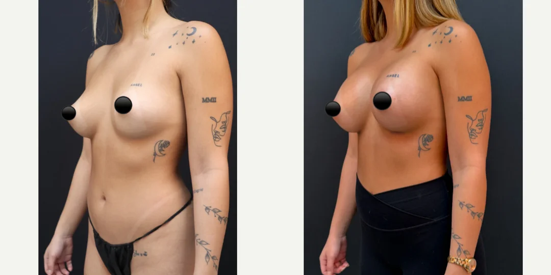 Breast Augmentation procedure image