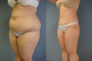 Skin Tightening procedure image