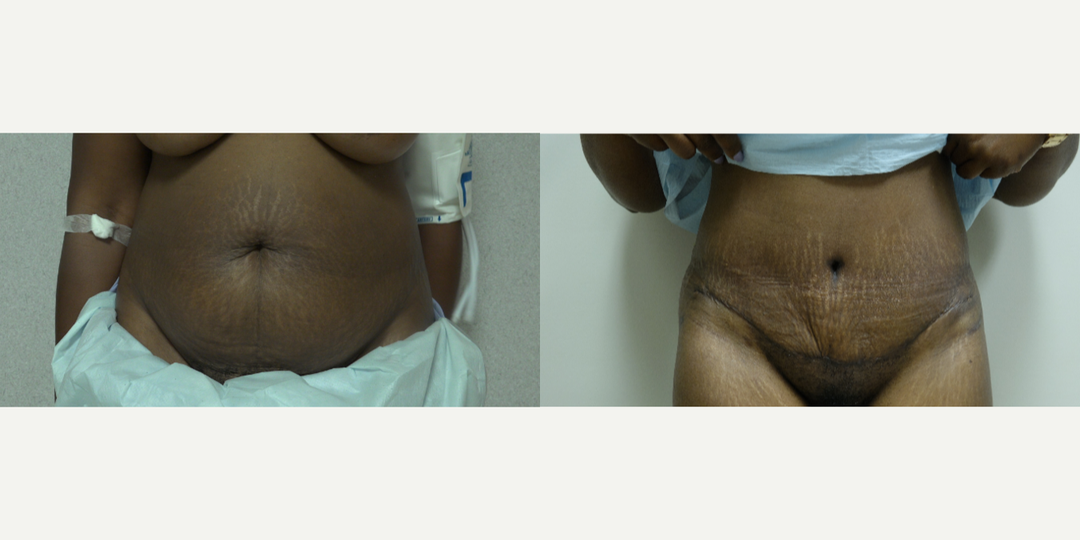 Tummy Tuck (Abdominoplasty) procedure image