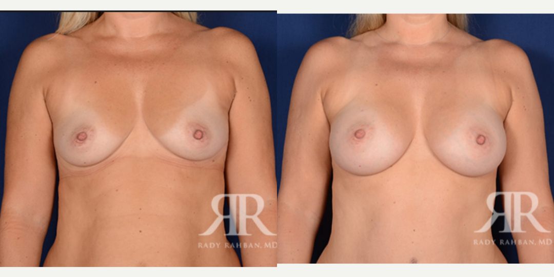 Breast Augmentation procedure image