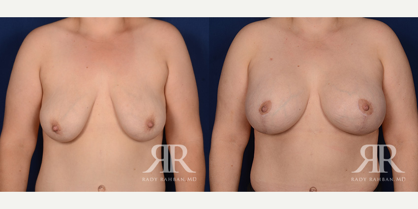 Mommy Makeover procedure image