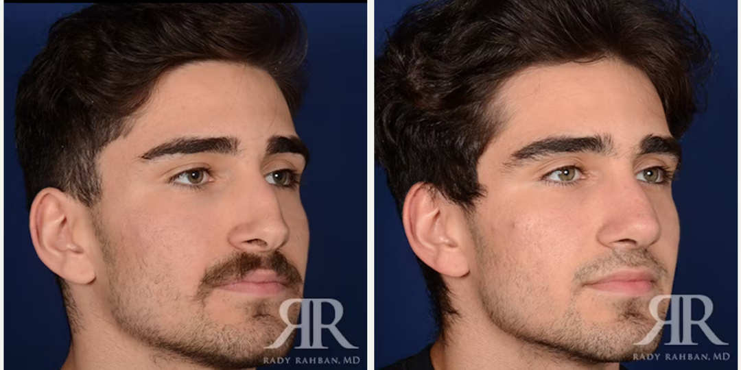 Rhinoplasty (Nose Job) procedure image