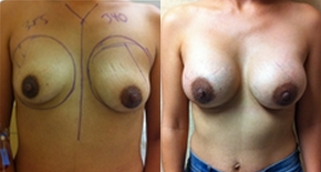 Mommy Makeover procedure image