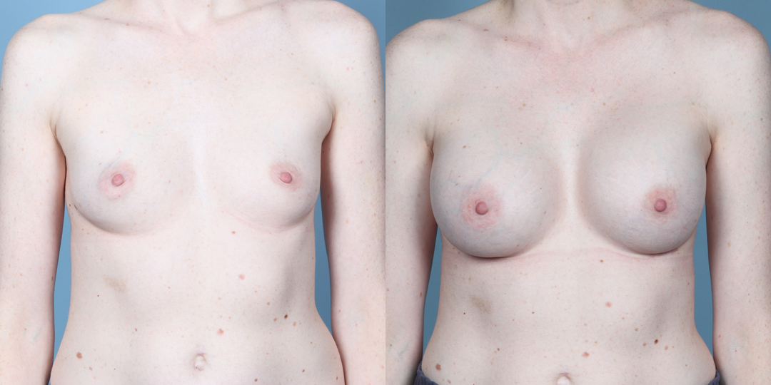 Mommy Makeover procedure image