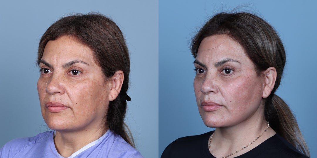 Facelift procedure image