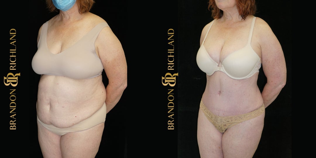 Breast Augmentation procedure image