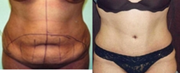 Tummy Tuck (Abdominoplasty) procedure image