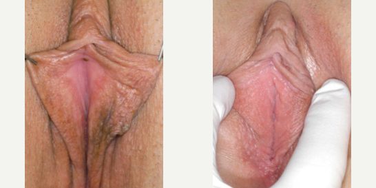 Labiaplasty procedure image