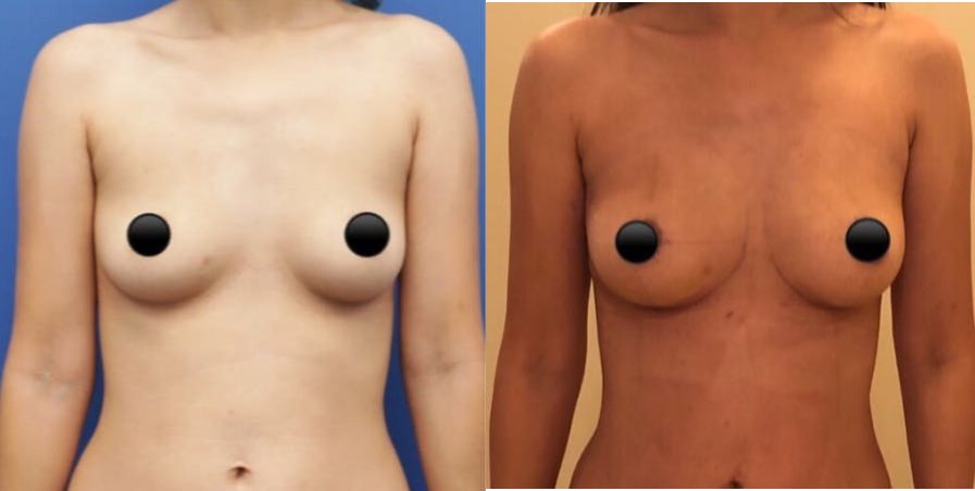 Breast Augmentation procedure image