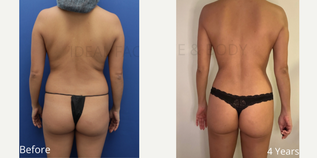 Brazilian Butt Lift (BBL) procedure image