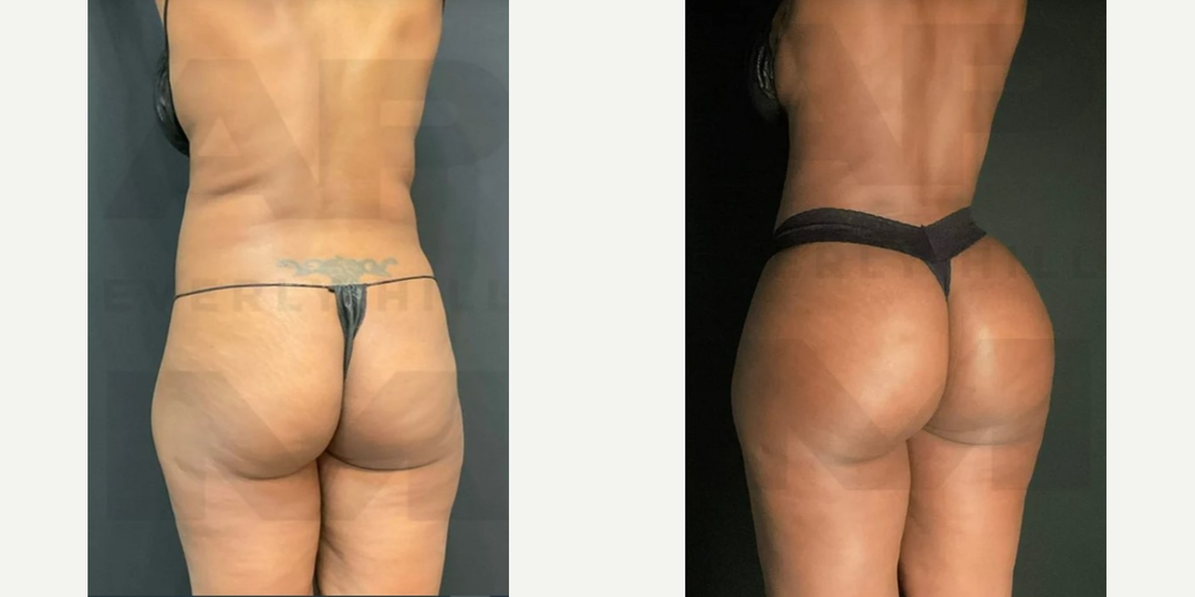 Hip Enhancement procedure image