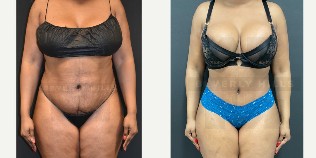 Mommy Makeover procedure image