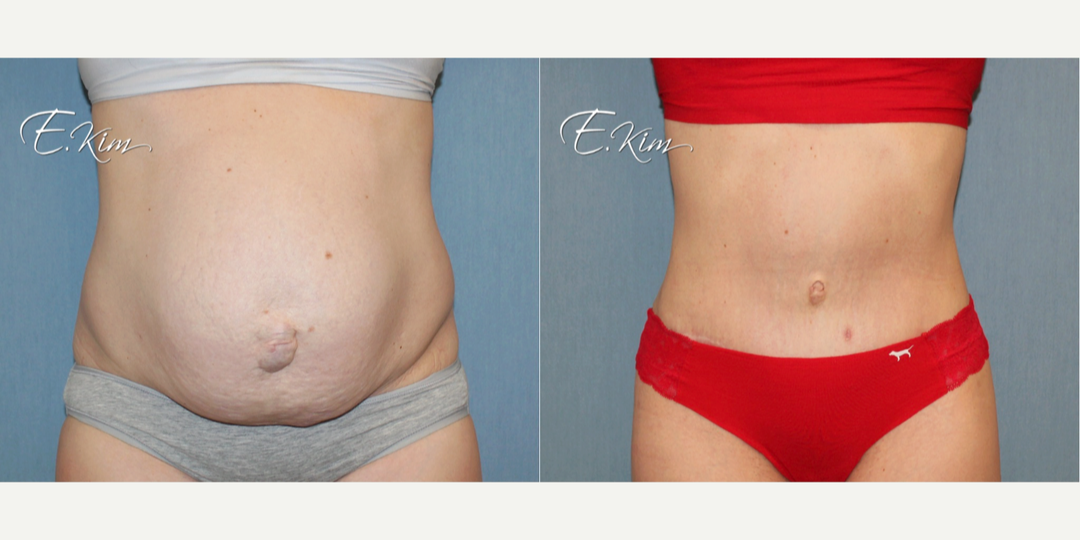 Skin Tightening procedure image