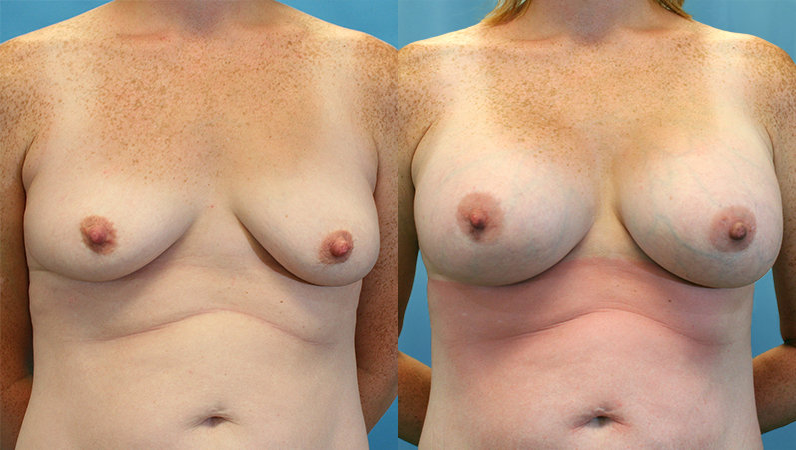 Breast Augmentation procedure image