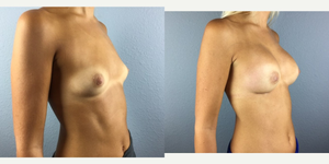 Breast Augmentation procedure image