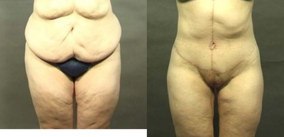 Body Lift procedure image