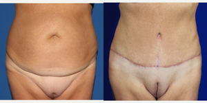 Tummy Tuck (Abdominoplasty) procedure image