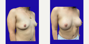 Breast Augmentation procedure image