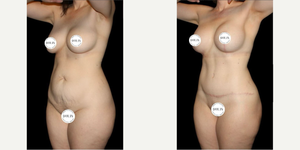 Breast Augmentation procedure image