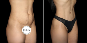 Mommy Makeover procedure image