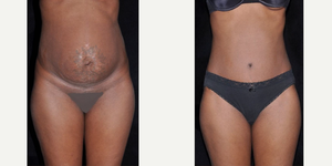 Tummy Tuck (Abdominoplasty) procedure image
