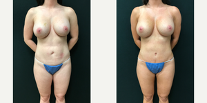 Tummy Tuck (Abdominoplasty) procedure image
