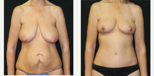 Breast Augmentation procedure image